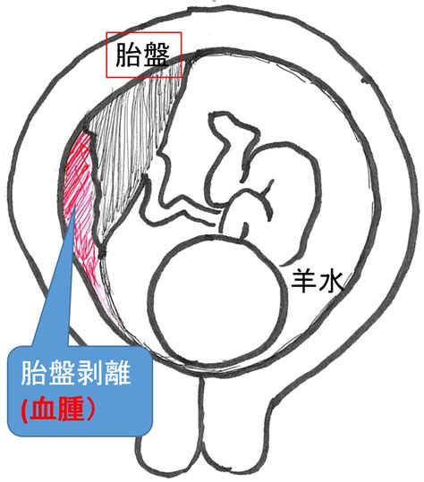 胎盤剝離後期|妊娠後期の怖い合併症：常位胎盤早期剥離って？ – 産婦人科オン。